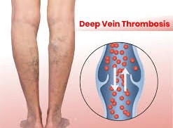 Understanding and Managing Thrombosis and Embolism of Blood Vessels Understanding and Managing Thrombosis and Embolism of Blood Vessels